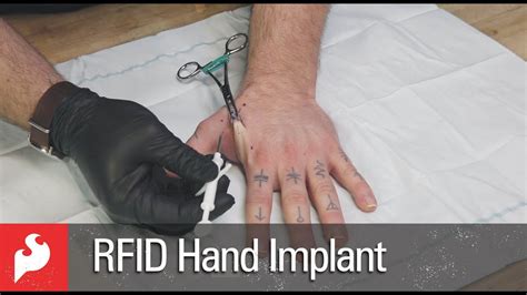 rfid chip will go in right hand|rfid implants before and after.